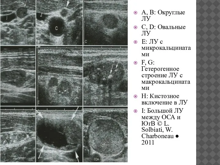 A, B: Округлые ЛУ C, D: Овальные ЛУ E: ЛУ с микрокальцинатами