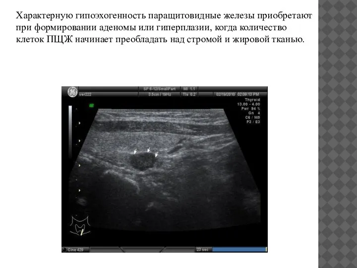 Характерную гипоэхогенность паращитовидные железы приобретают при формировании аденомы или гиперплазии, когда количество