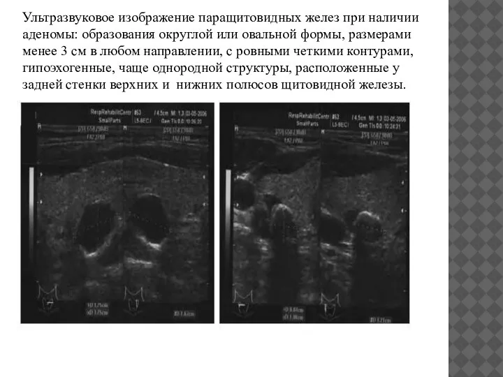Ультразвуковое изображение паращитовидных желез при наличии аденомы: образования округлой или овальной формы,