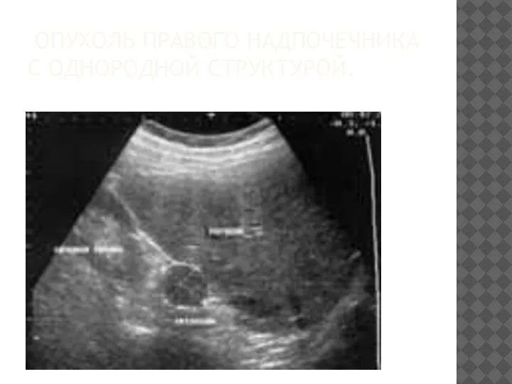 ОПУХОЛЬ ПРАВОГО НАДПОЧЕЧНИКА С ОДНОРОДНОЙ СТРУКТУРОЙ.