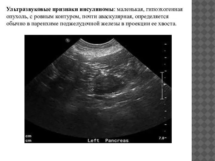 Ультразвуковые признаки инсулиномы: маленькая, гипоэхогенная опухоль, с ровным контуром, почти аваскулярная, определяется