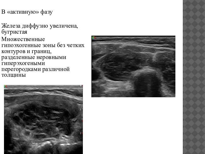 В «активную» фазу Железа диффузно увеличена, бугристая Множественные гипоэхогенные зоны без четких