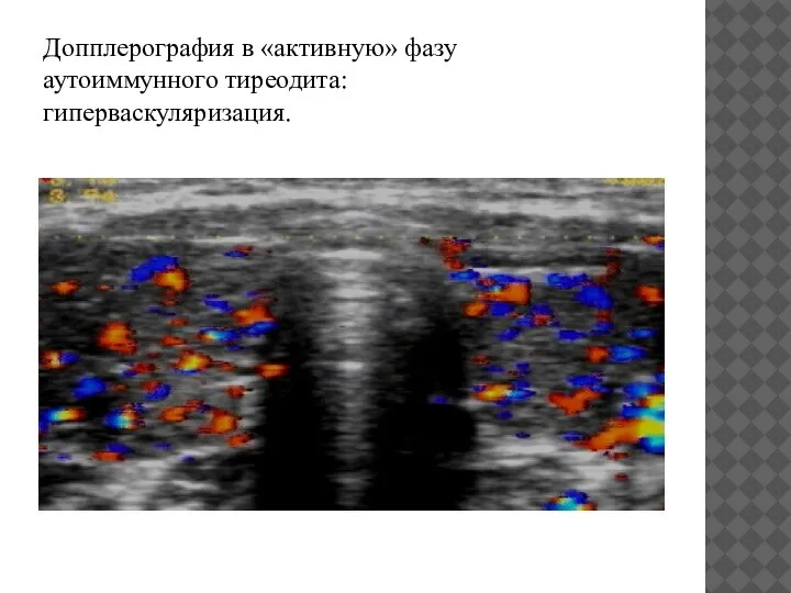 Допплерография в «активную» фазу аутоиммунного тиреодита: гиперваскуляризация.