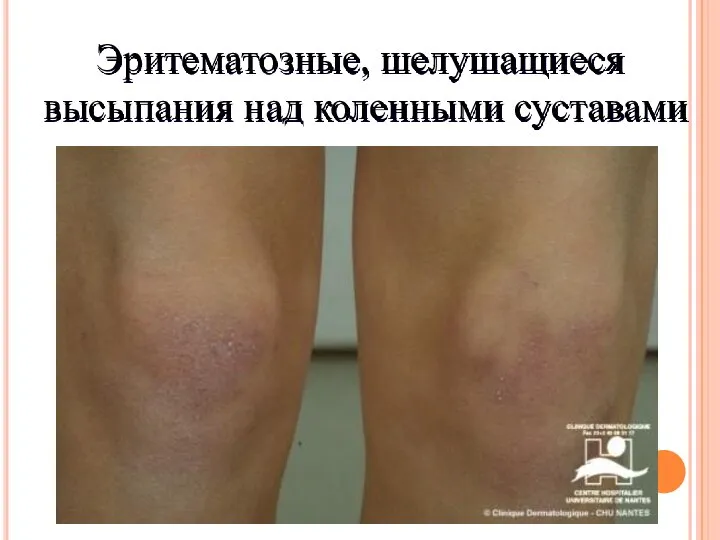 Эритематозные, шелушащиеся высыпания над коленными суставами