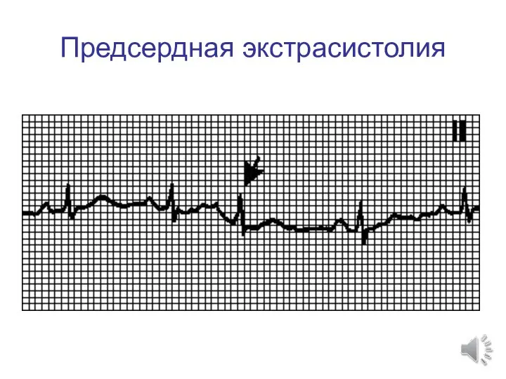 Предсердная экстрасистолия