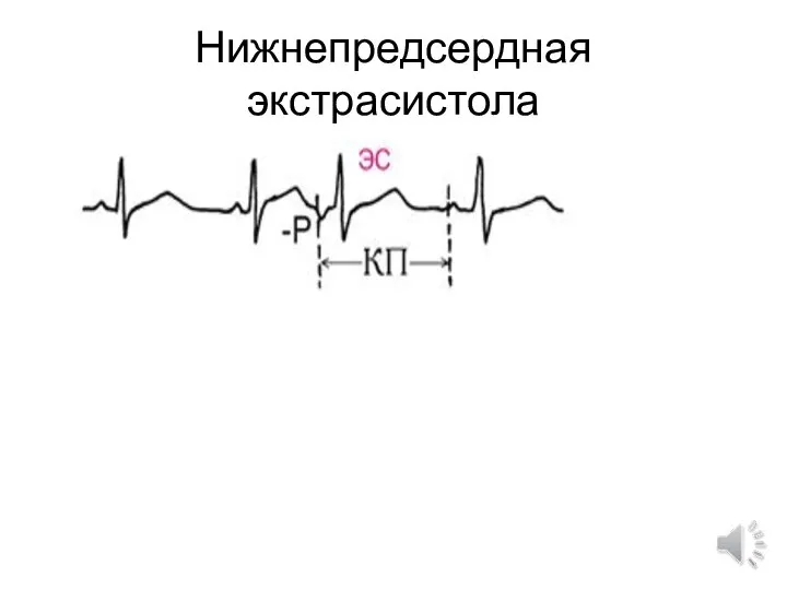 Нижнепредсердная экстрасистола