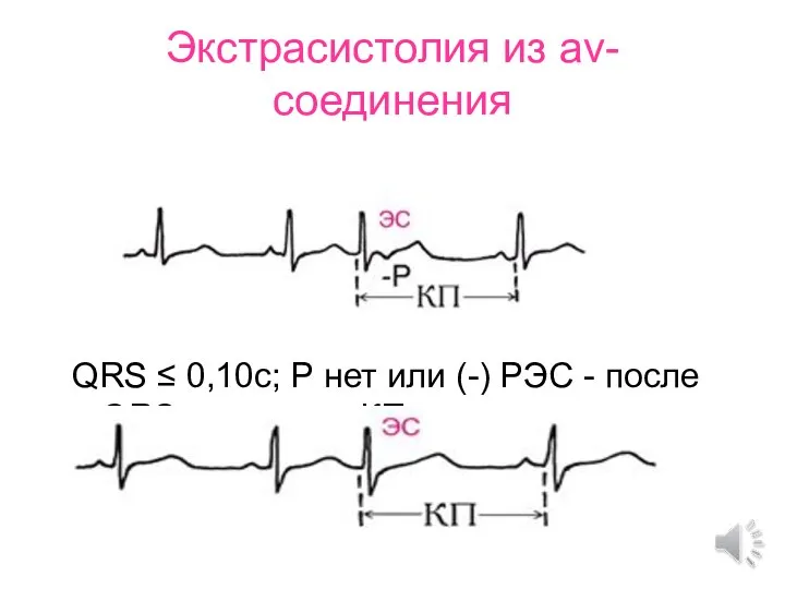 Экстрасистолия из av-соединения QRS ≤ 0,10с; Р нет или (-) РЭС - после QRS; неполная КП.