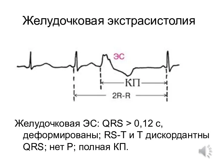 Желудочковая экстрасистолия Желудочковая ЭС: QRS > 0,12 c, деформированы; RS-T и Т