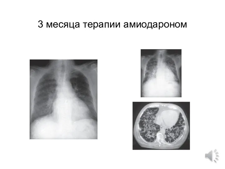 3 месяца терапии амиодароном