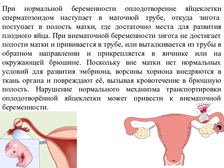 При нормальной беременности оплодотворение яйцеклетки сперматозоидом наступает в маточной трубе, откуда зигота