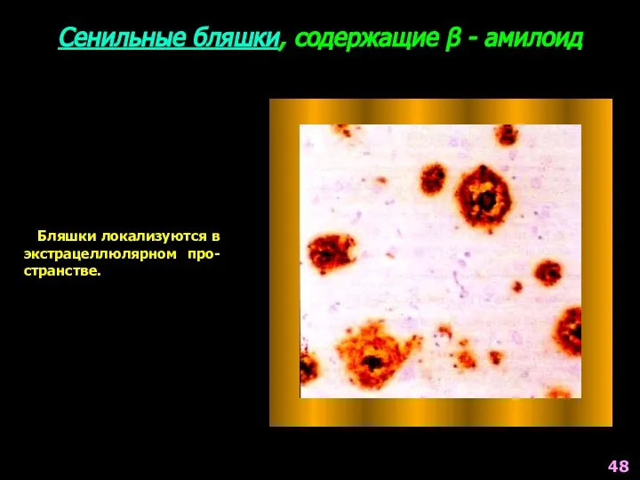 Сенильные бляшки, содержащие β - амилоид Бляшки локализуются в экстрацеллюлярном про-странстве. 48