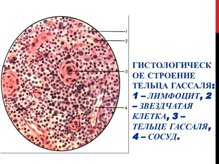 ГИСТОЛОГИЧЕСКОЕ СТРОЕНИЕ ТЕЛЬЦА ГАССАЛЯ: 1 – ЛИМФОЦИТ, 2 – ЗВЕЗДЧАТАЯ КЛЕТКА, 3