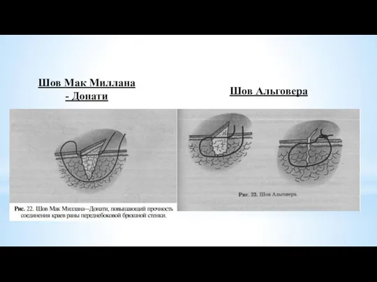 Шов Мак Миллана - Донати Шов Альговера