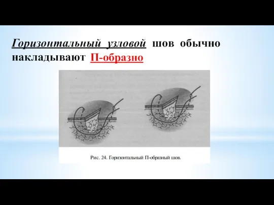 Горизонтальный узловой шов обычно накладывают П-образно