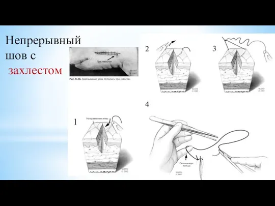 Непрерывный шов с захлестом