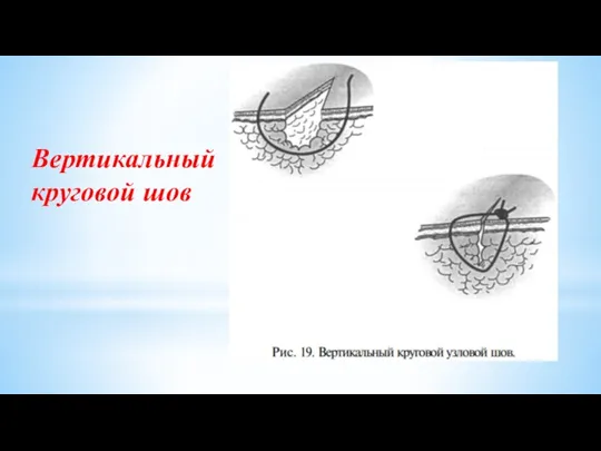 Вертикальный круговой шов