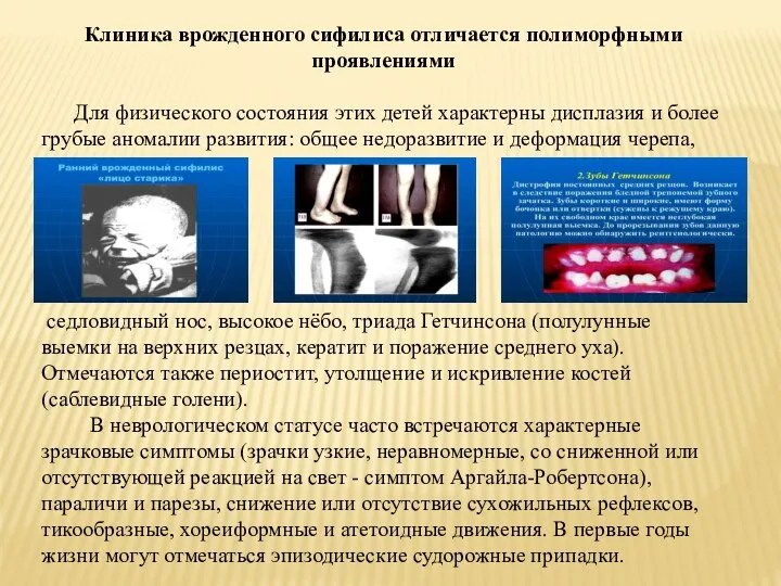 Клиника врожденного сифилиса отличается полиморфными проявлениями Для физического состояния этих детей характерны