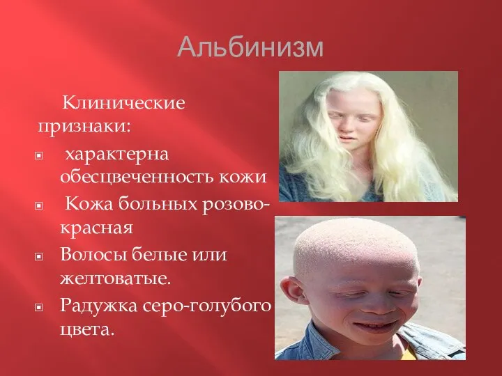 Альбинизм Клинические признаки: характерна обесцвеченность кожи Кожа больных розово-красная Волосы белые или желтоватые. Радужка серо-голубого цвета.