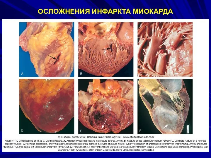 ОСЛОЖНЕНИЯ ИНФАРКТА МИОКАРДА