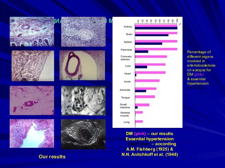 ДИАБЕТИЧЕСКАЯ МИКРОАНГИОПАТИЯ Оur results Percentage of different organs involved in arteriolosclerosis on