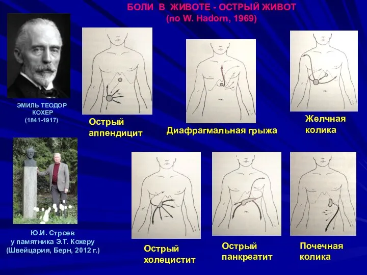 БОЛИ В ЖИВОТЕ - ОСТРЫЙ ЖИВОТ (по W. Hadorn, 1969) Острый панкреатит