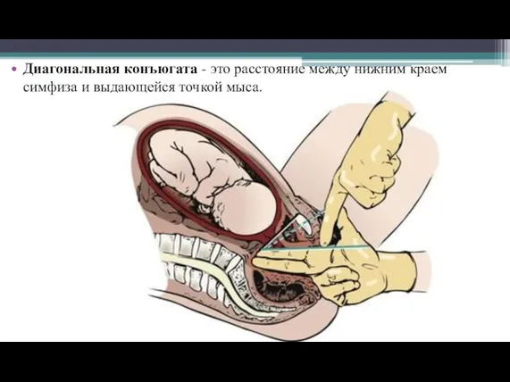 Диагональная конъюгата - это расстояние между нижним краем симфиза и выдающейся точкой мыса.