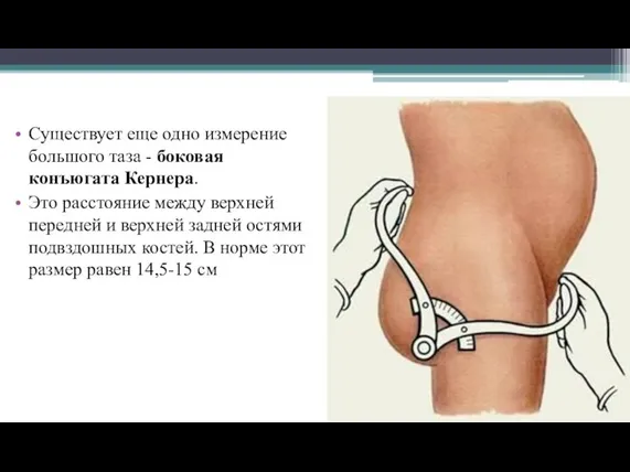 Существует еще одно измерение большого таза - боковая конъюгата Кернера. Это расстояние