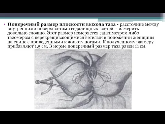 Поперечный размер плоскости выхода таза - расстояние между внутренними поверхностями седалищных костей