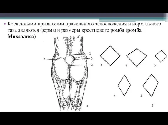 Косвенными признаками правильного телосложения и нормального таза являются формы и размеры крестцового ромба (ромба Михаэлиса)