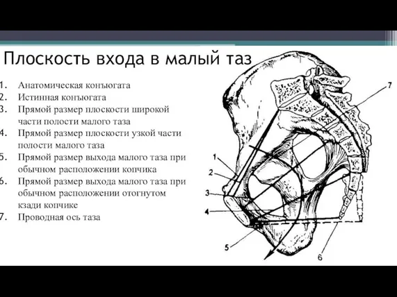 Анатомическая конъюгата Истинная конъюгата Прямой размер плоскости широкой части полости малого таза