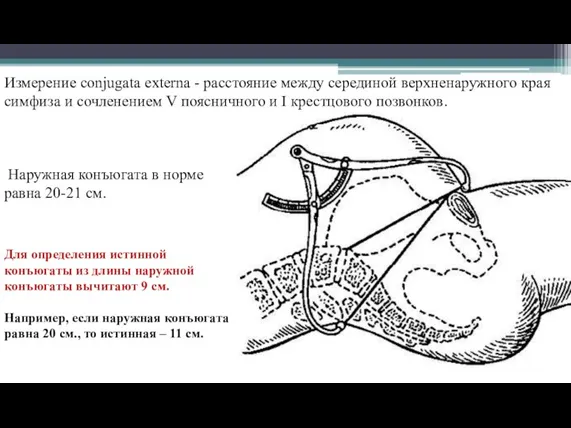 Измерение сonjugata externa - расстояние между серединой верхненаружного края симфиза и сочленением