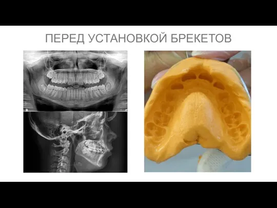 ПЕРЕД УСТАНОВКОЙ БРЕКЕТОВ