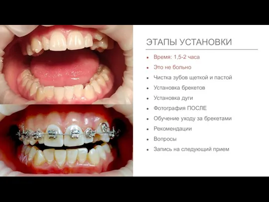 Время: 1,5-2 часа Это не больно Чистка зубов щеткой и пастой Установка