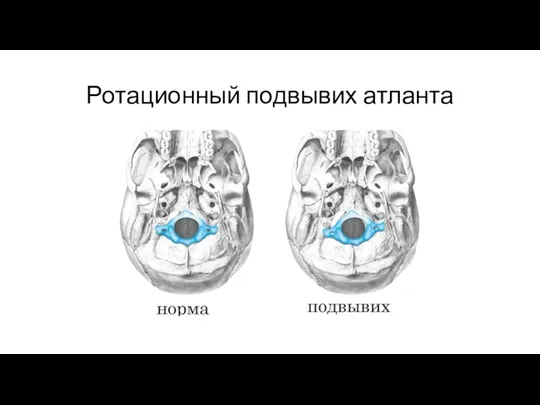 Ротационный подвывих атланта