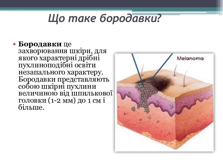 Що таке бородавки? Бородавки це захворювання шкіри, для якого характерні дрібні пухлиноподібні