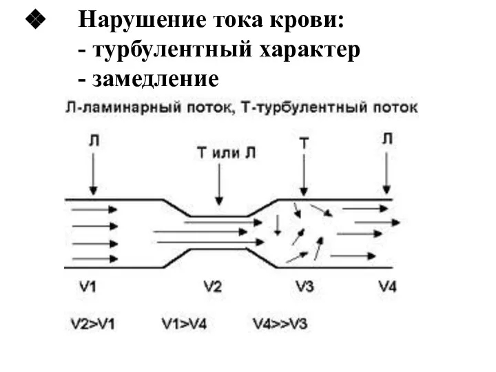 Нарушение тока крови: - турбулентный характер - замедление