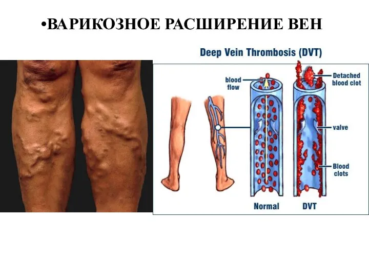 ВАРИКОЗНОЕ РАСШИРЕНИЕ ВЕН