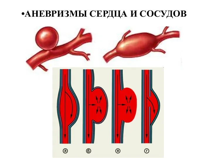 АНЕВРИЗМЫ СЕРДЦА И СОСУДОВ