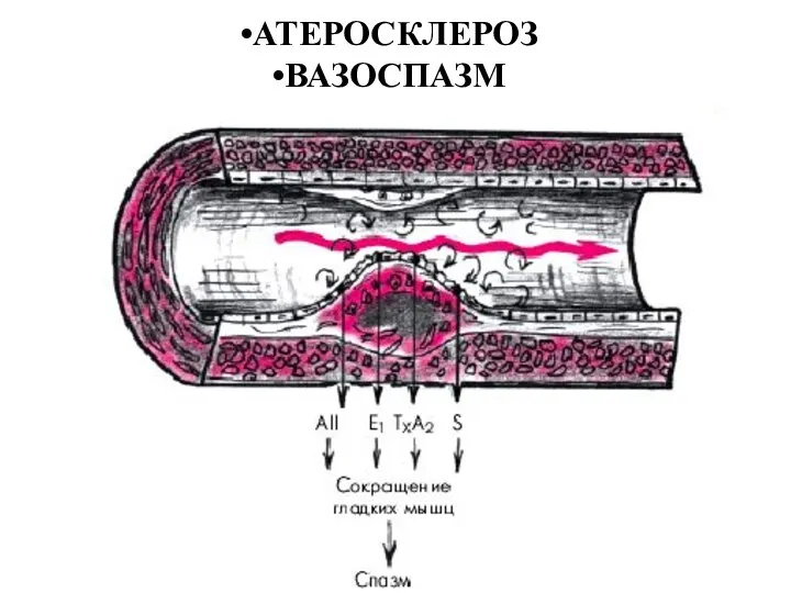 АТЕРОСКЛЕРОЗ ВАЗОСПАЗМ