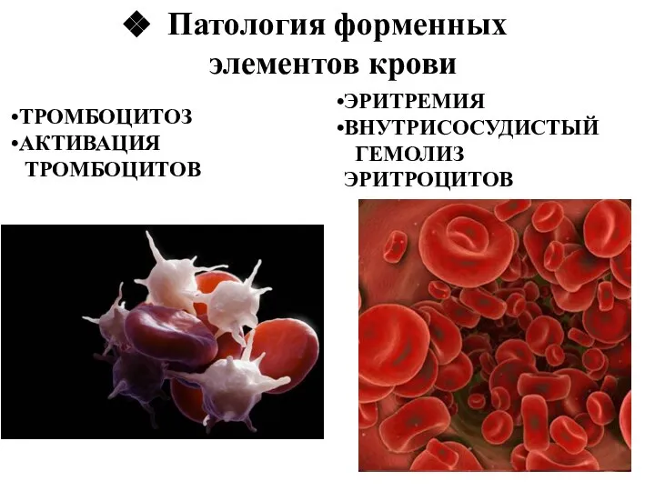 Патология форменных элементов крови ТРОМБОЦИТОЗ АКТИВАЦИЯ ТРОМБОЦИТОВ ЭРИТРЕМИЯ ВНУТРИСОСУДИСТЫЙ ГЕМОЛИЗ ЭРИТРОЦИТОВ