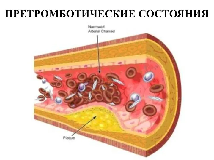 ПРЕТРОМБОТИЧЕСКИЕ СОСТОЯНИЯ