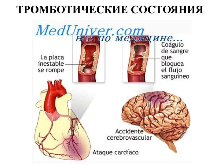 ТРОМБОТИЧЕСКИЕ СОСТОЯНИЯ