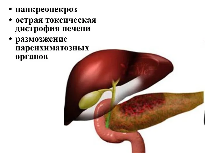 панкреонекроз острая токсическая дистрофия печени размозжение паренхиматозных органов