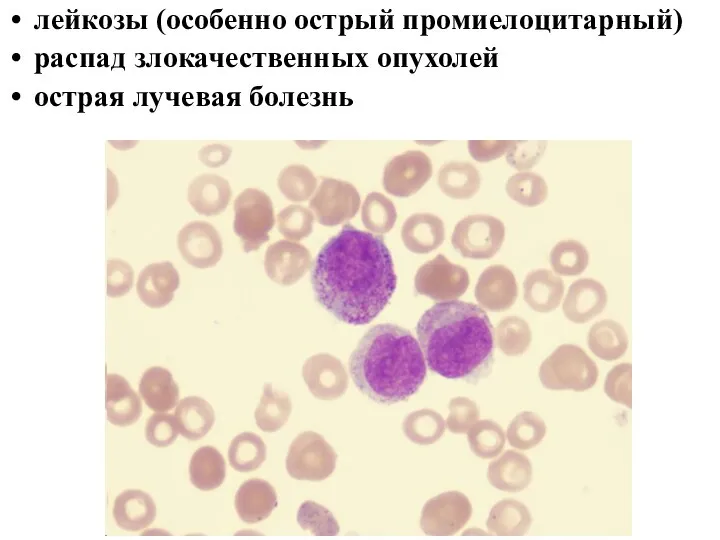 лейкозы (особенно острый промиелоцитарный) распад злокачественных опухолей острая лучевая болезнь