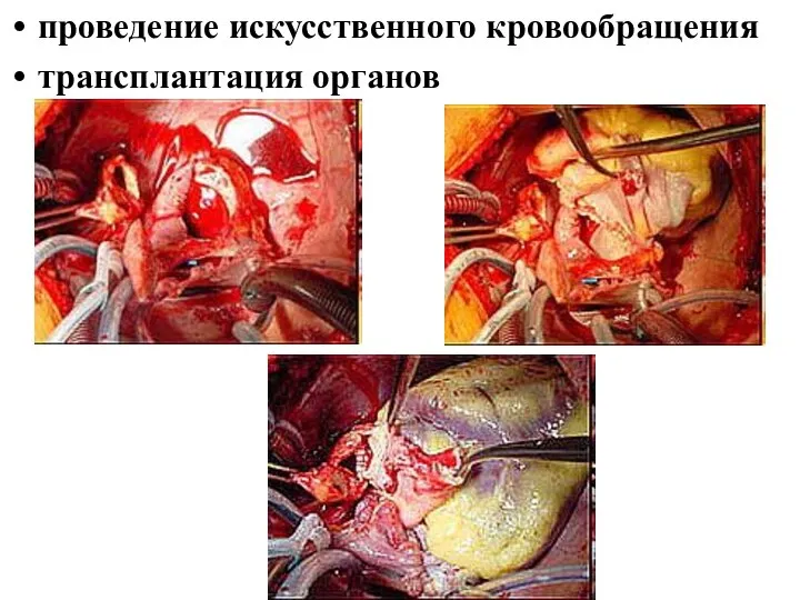 проведение искусственного кровообращения трансплантация органов