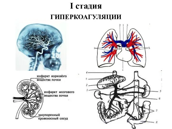 I стадия ГИПЕРКОАГУЛЯЦИИ