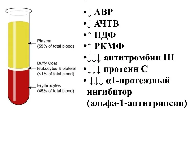 ↓ АВР ↓ АЧТВ ↑ ПДФ ↑ РКМФ ↓↓↓ антитромбин III ↓↓↓