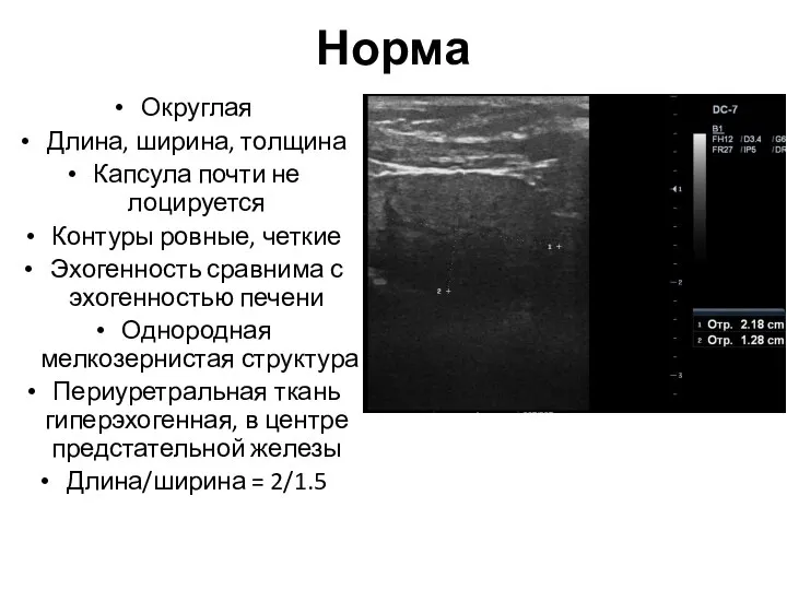 Норма Округлая Длина, ширина, толщина Капсула почти не лоцируется Контуры ровные, четкие