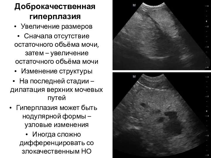 Доброкачественная гиперплазия Увеличение размеров Сначала отсутствие остаточного объёма мочи, затем – увеличение