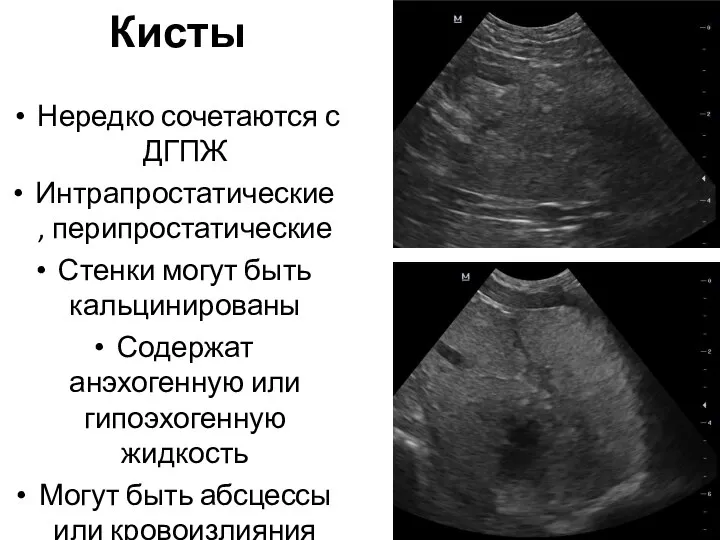 Кисты Нередко сочетаются с ДГПЖ Интрапростатические, перипростатические Стенки могут быть кальцинированы Содержат